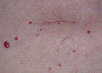 Skin showing cherry angioma vs spider angioma with raised red spots and branching visible blood vessels