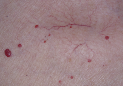 Skin showing cherry angioma vs spider angioma with raised red spots and branching visible blood vessels