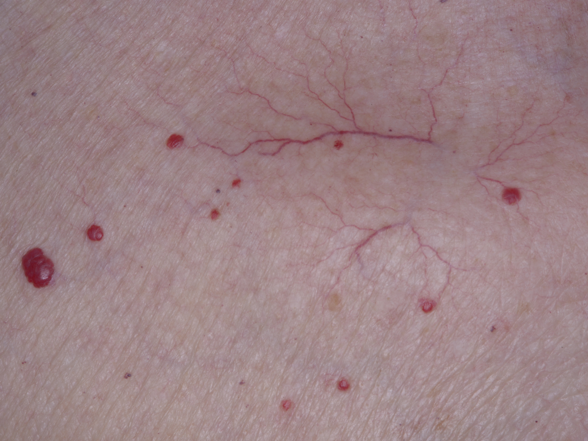 Skin showing cherry angioma vs spider angioma with raised red spots and branching visible blood vessels