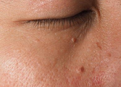 Close-up of skin tags on the neck showing what causes skin tags in friction-prone areas