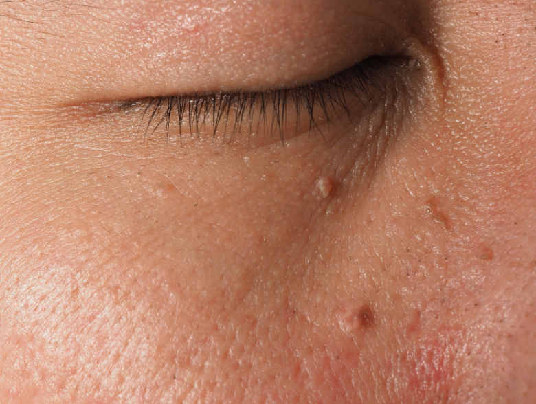 Close-up of skin tags on the neck showing what causes skin tags in friction-prone areas