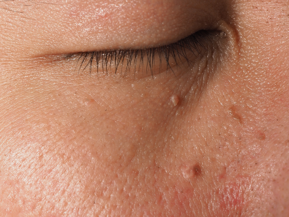 Close-up of skin tags on the neck showing what causes skin tags in friction-prone areas