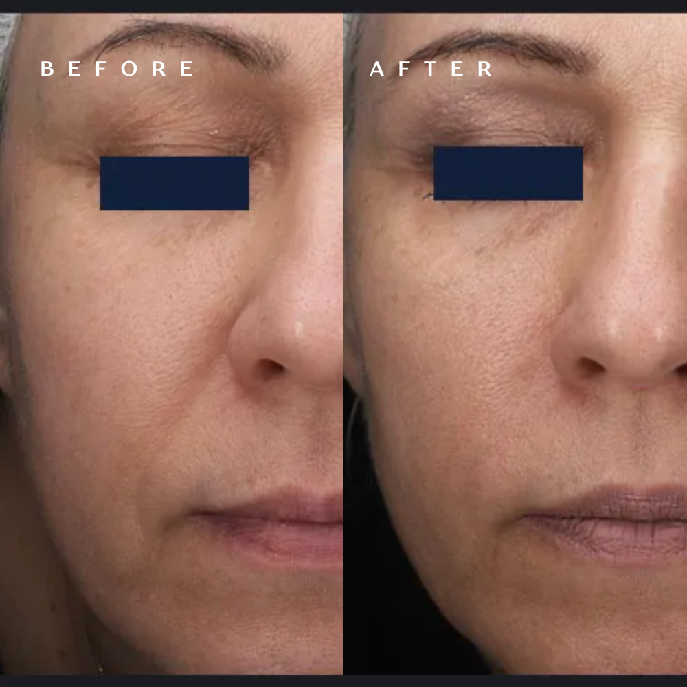 Before and after RF microneedling showing smoother under-eye and cheek texture at DaVida in San Antonio