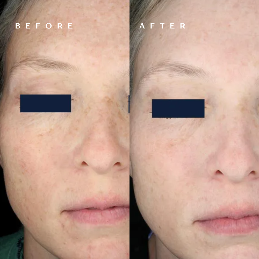 Before and after RF microneedling showing reduced sun spots and more even skin tone at DaVida in San Antonio