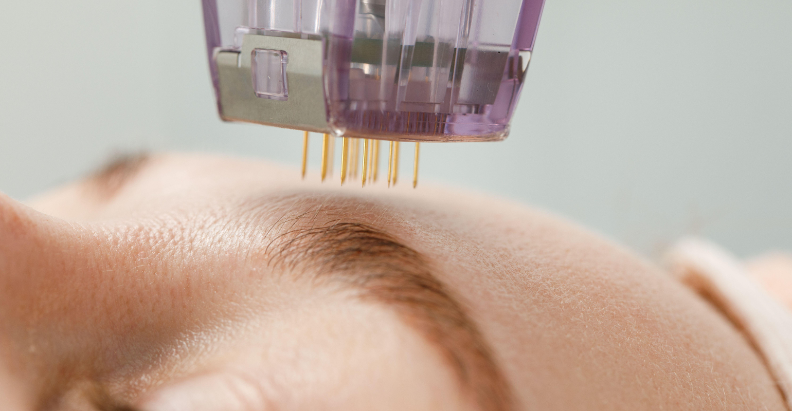 Matrix RF microneedling handpiece with fine gold needles treating a woman's forehead at DaVida in San Antonio