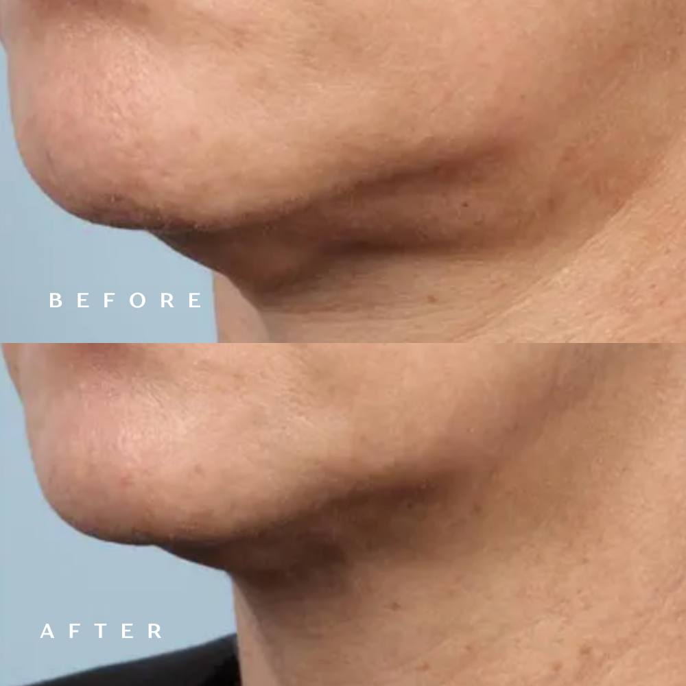 Before and after RF microneedling showing a firmer, more defined jawline and neck at DaVida in San Antonio