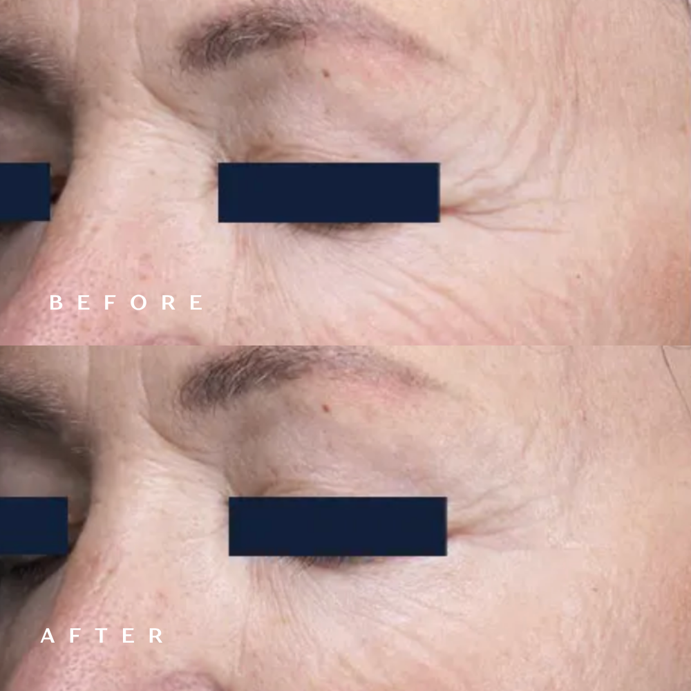 Before and after RF microneedling showing softened crow's feet and fine lines around the eye at DaVida in San Antonio
