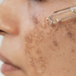 Close-up of symmetrical melasma patches on a woman's cheeks