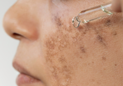 Close-up of symmetrical melasma patches on a woman's cheeks