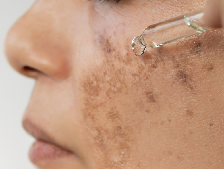 Close-up of symmetrical melasma patches on a woman's cheeks