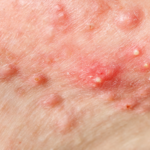 Close-up of inflamed cystic acne along a person's skin