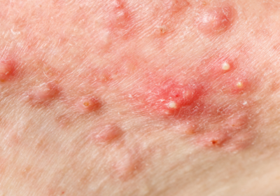 Close-up of inflamed cystic acne along a person's skin