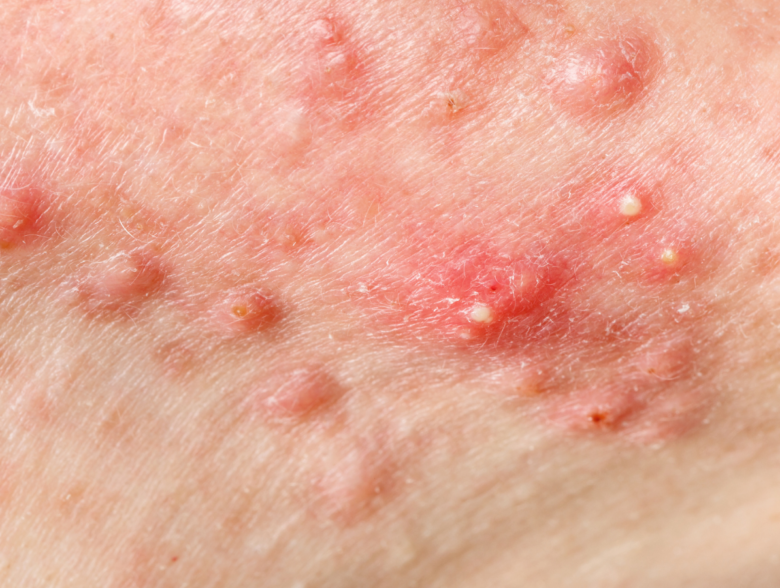 Close-up of inflamed cystic acne along a person's skin