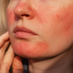 Close-up of facial redness and visible blood vessels from rosacea on the cheeks