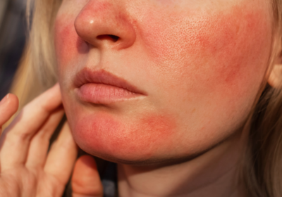 Close-up of facial redness and visible blood vessels from rosacea on the cheeks