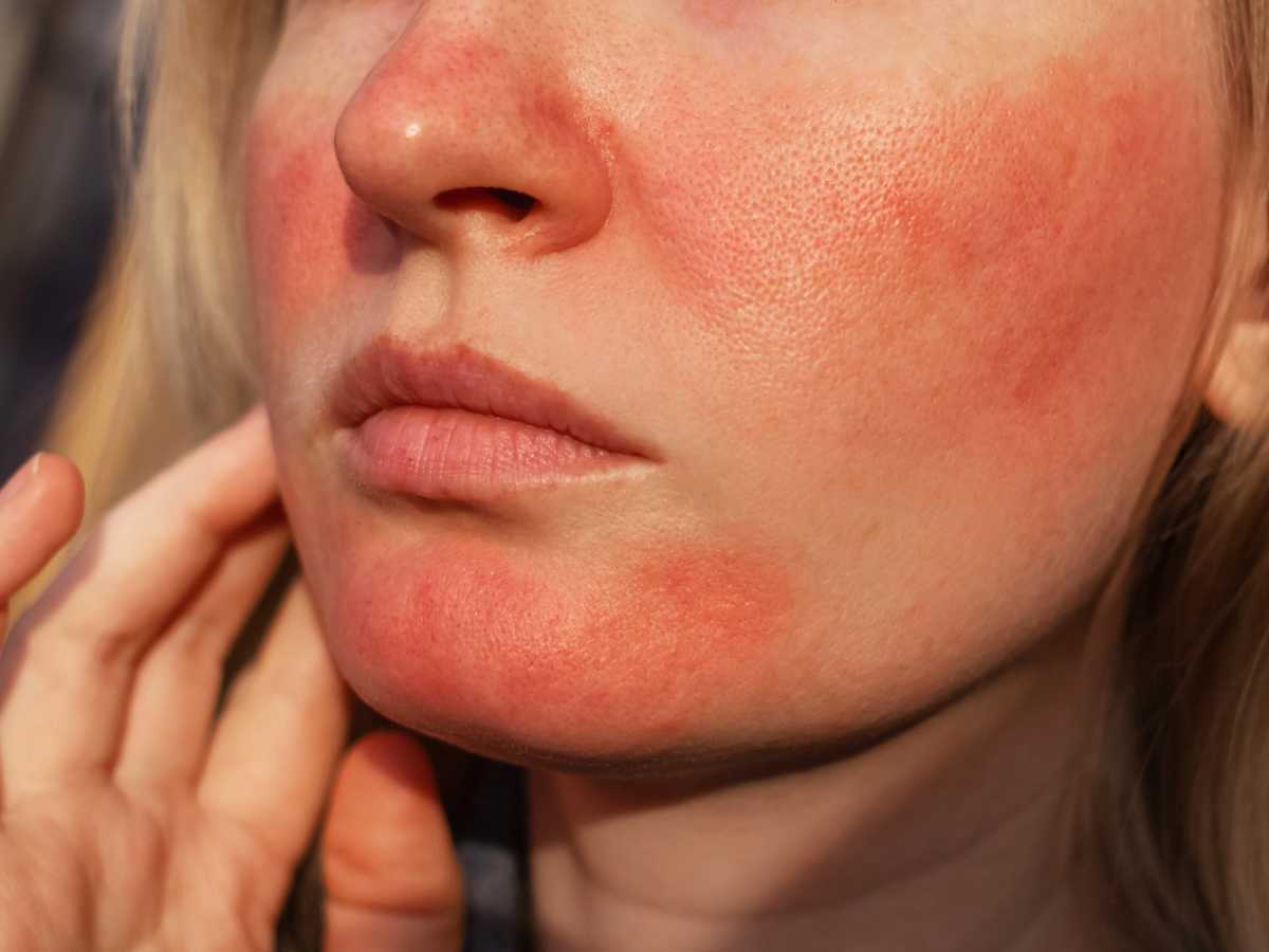 Close-up of facial redness and visible blood vessels from rosacea on the cheeks