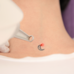 Technician performing laser tattoo removal on a client's forearm at a San Antonio med spa