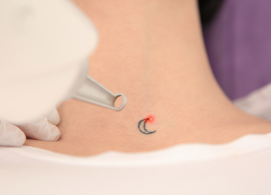 Technician performing laser tattoo removal on a client's forearm at a San Antonio med spa