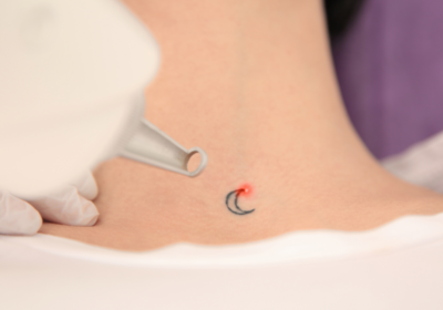 Technician performing laser tattoo removal on a client's forearm at a San Antonio med spa