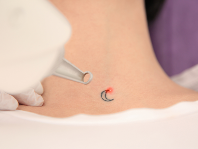 Technician performing laser tattoo removal on a client's forearm at a San Antonio med spa