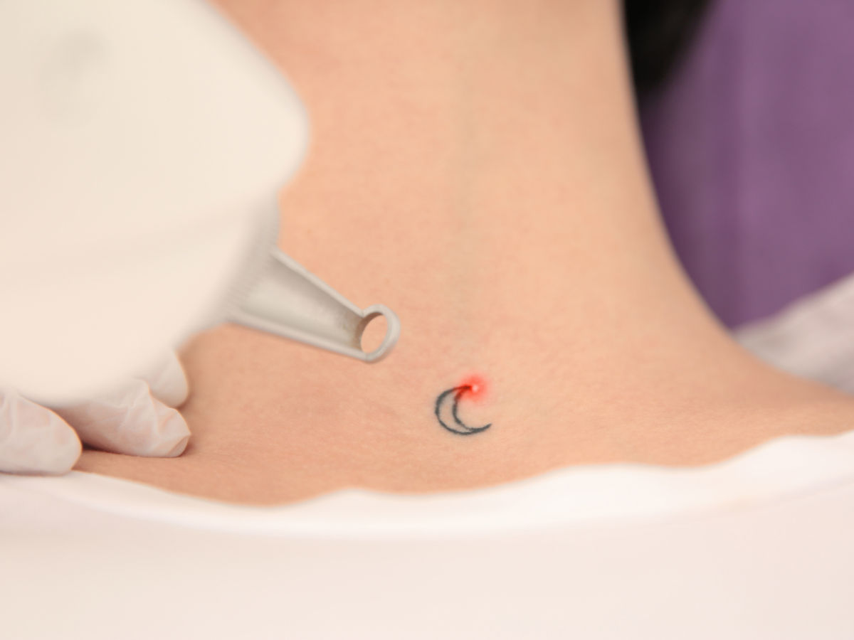 Technician performing laser tattoo removal on a client's forearm at a San Antonio med spa